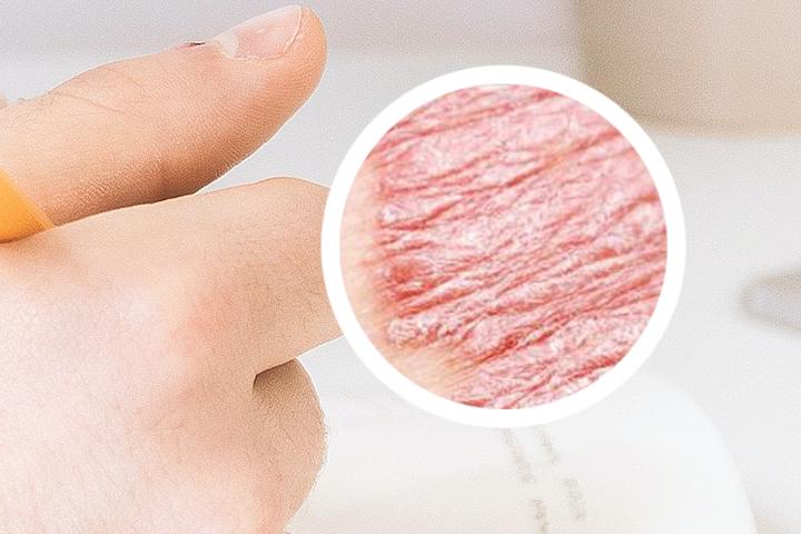 银屑病传染吗