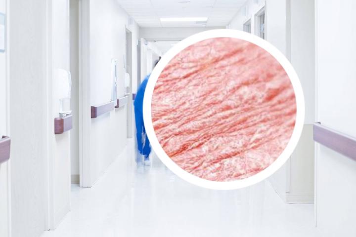 银屑病消退顺序