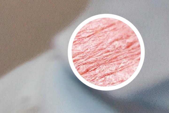 清除牛皮癣导入