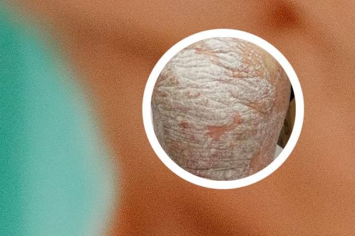 牛皮癣患者必读书