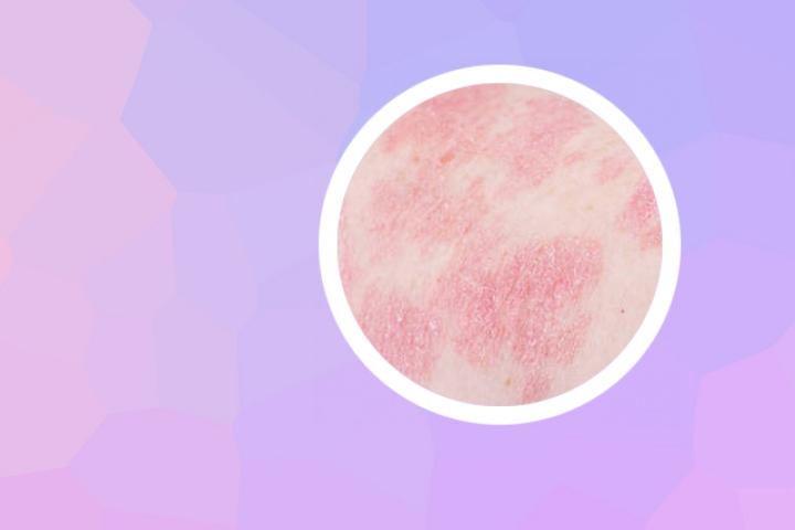 沈阳针灸治疗牛皮癣