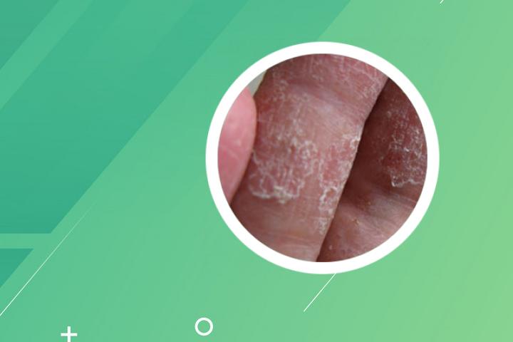 银屑病做抗核抗体