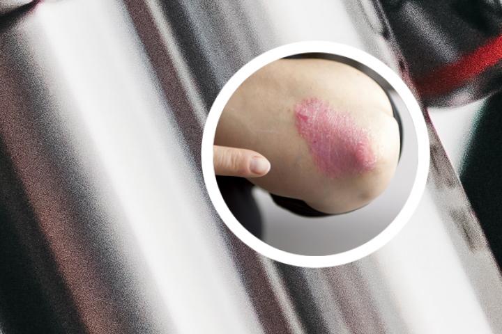 银屑病切口感染
