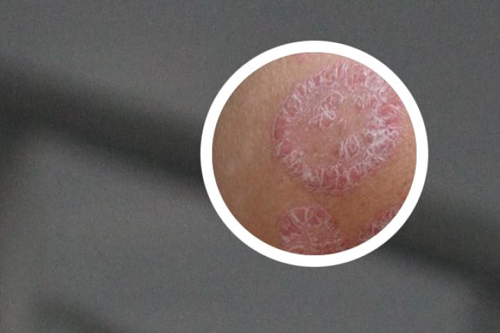 生物制剂能否有效缓解银屑病关节炎症状
