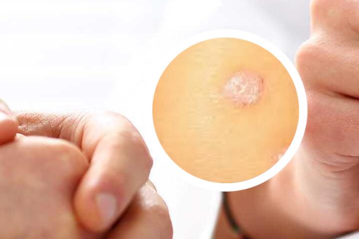 冶了银屑病的药物