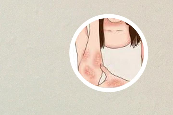 怀来的牛皮癣怎么治