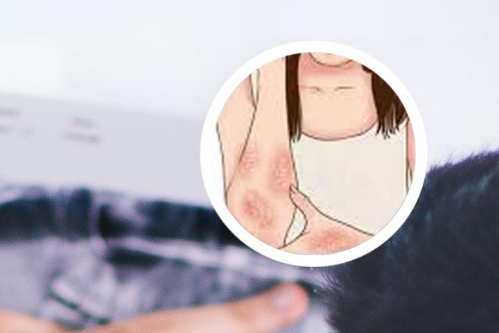 头部银屑病涂抹偏方