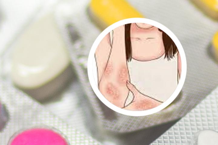 牛皮癣愈后变白