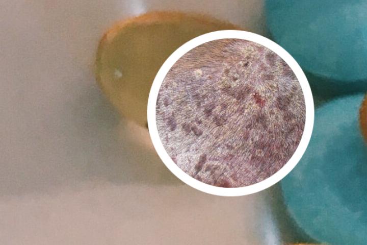 净肤堂治疗牛皮癣效果如何