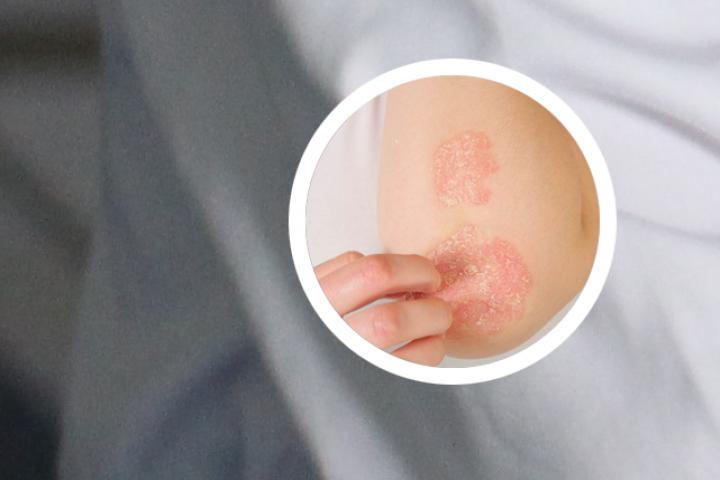 银屑病患者能否用温水泡澡浴缸