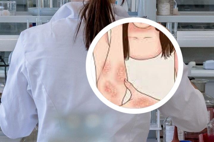 六岁的孩子得了银屑病怎么办
