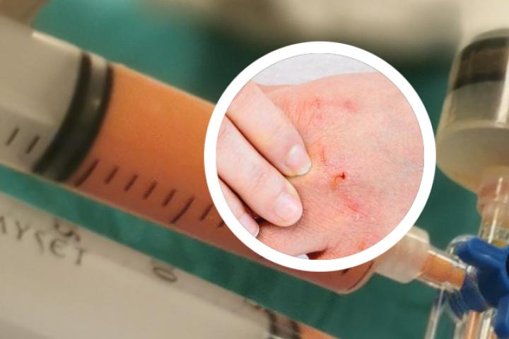 银屑病注意事项