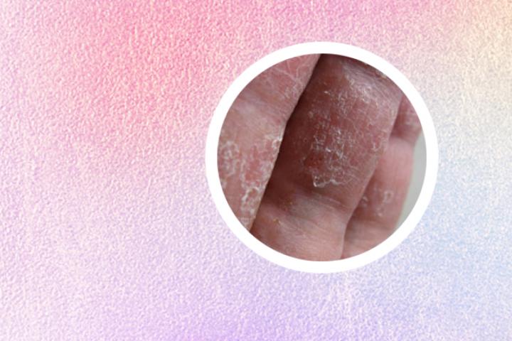 八部金刚功治好了银屑病