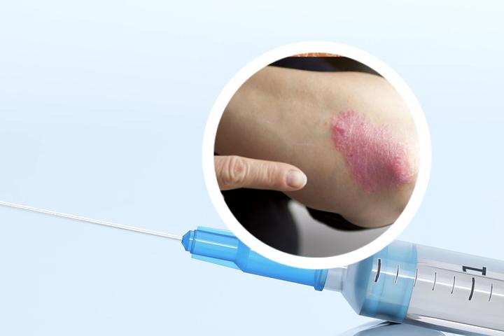银屑病跟hiv有关系吗