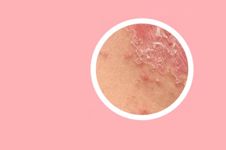 女性臀部银屑病