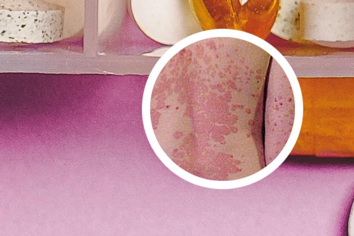阿维a治疗银屑病使用方法