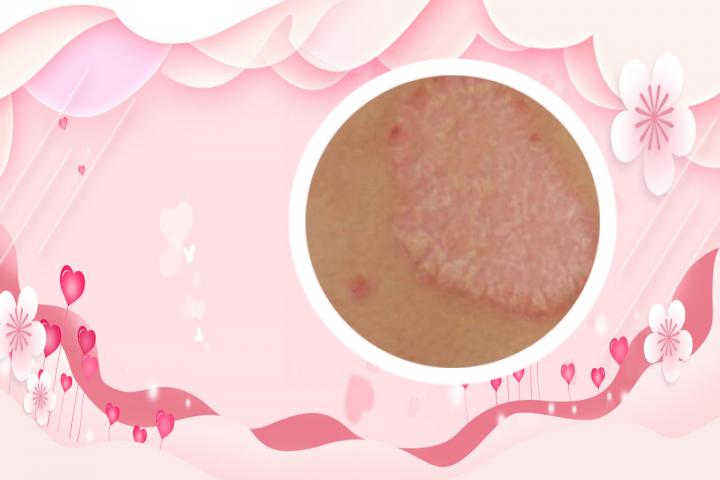 银屑病易感基因