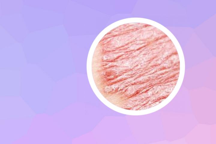 不是所有银屑病都复发