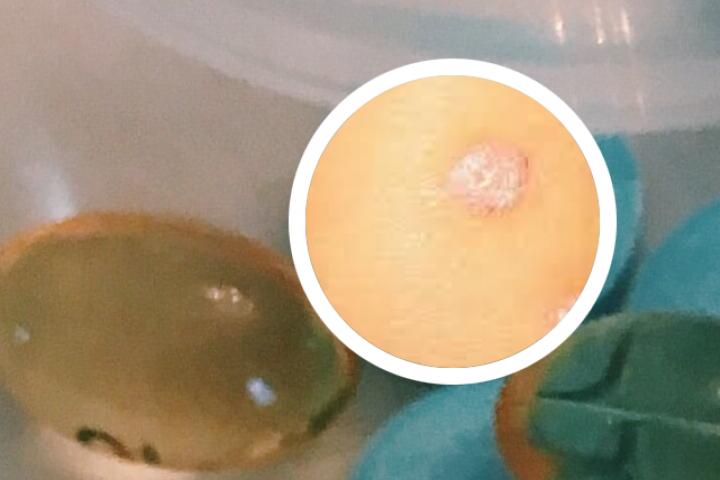 有没有什么简单有效的银屑病偏方