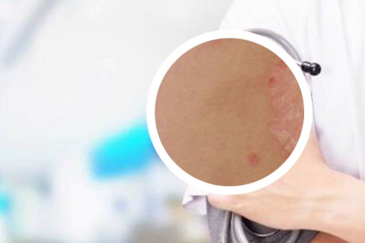 银屑病手脚发热回事