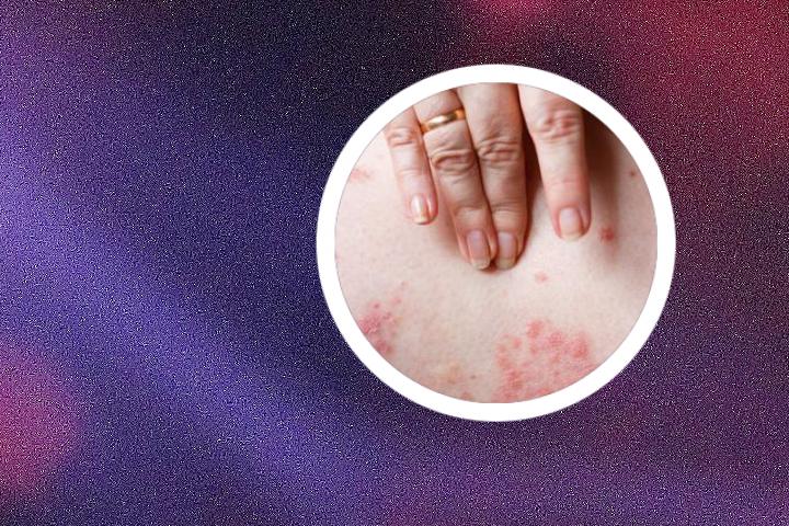 银屑病关节炎复发如何预防