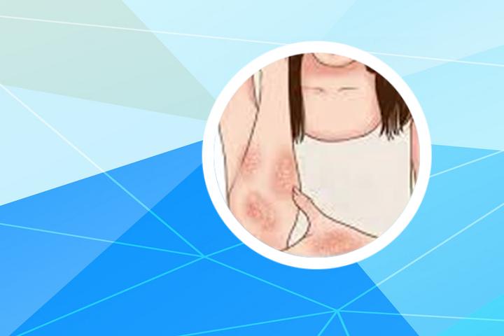 银屑病坚果可以吃吗