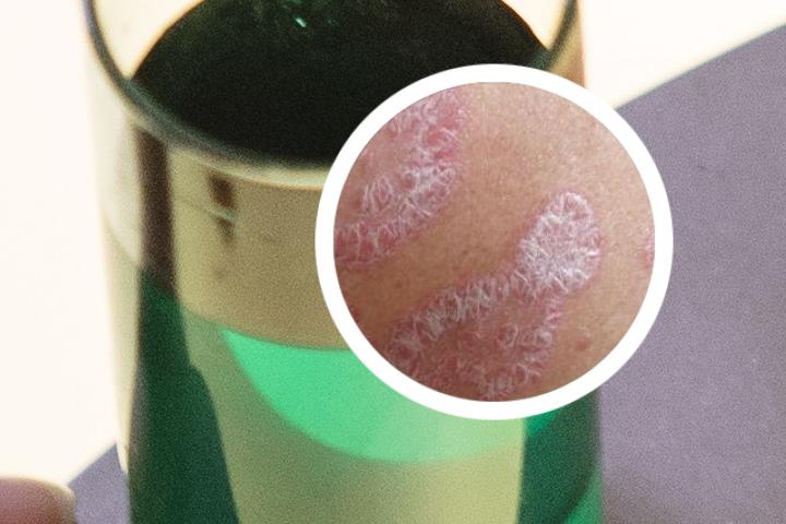 牛皮癣下肢浮肿