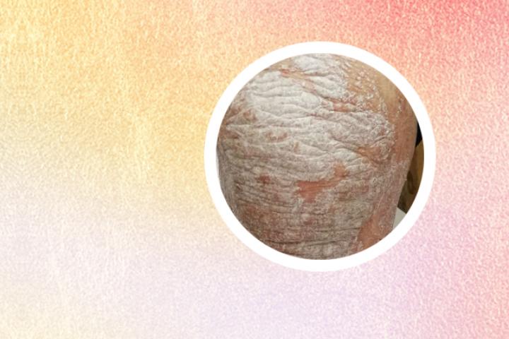银屑病用艾草泡澡好吗