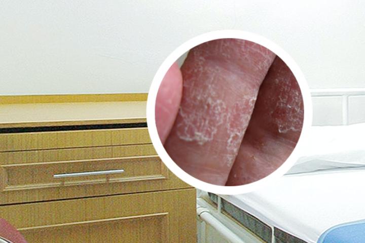 银屑病光动力