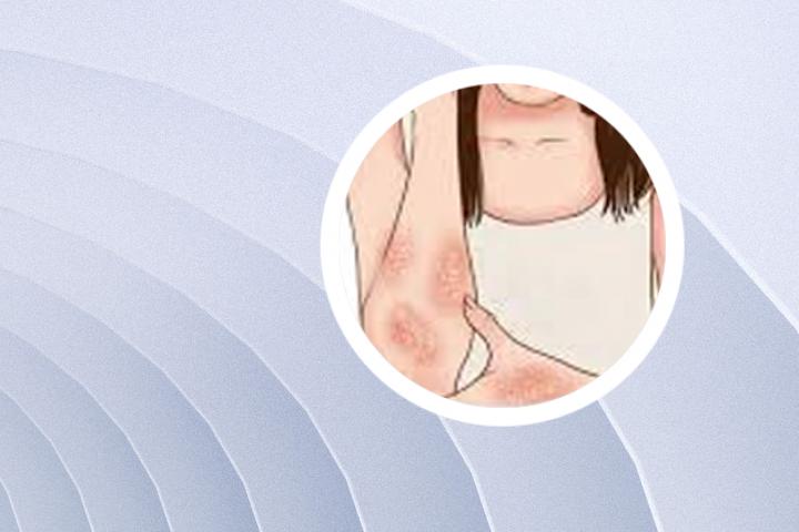 如何治疗崩会县银屑病