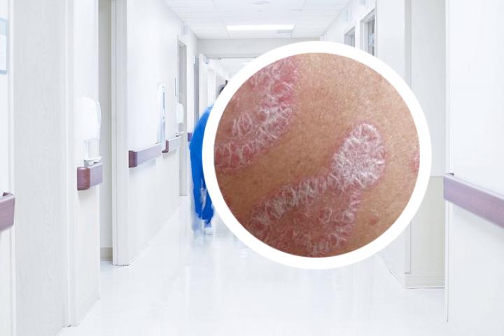 协和银屑病临床招募