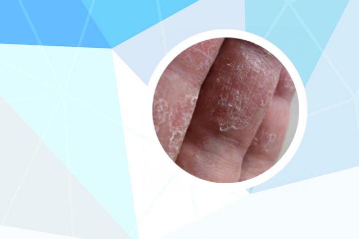 艾滋病后出银屑病症状