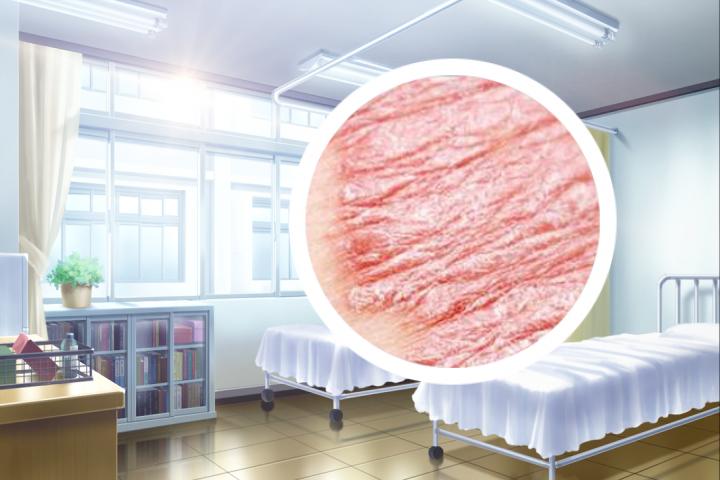 银屑病关节炎的偏方