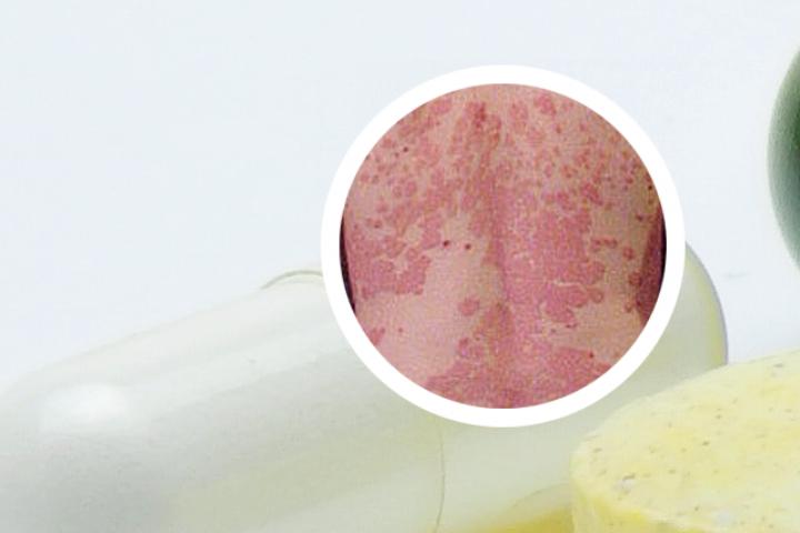 牛皮癣擦猪肉有用吗