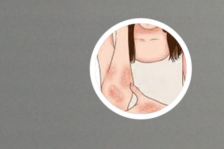 牛皮癣能拿生姜洗头吗