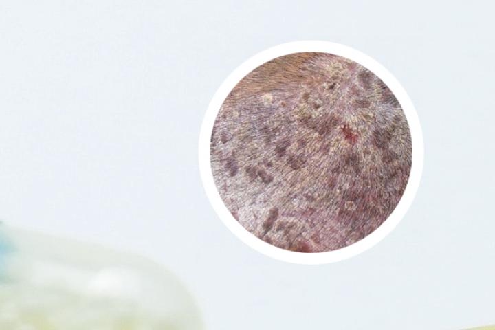 银屑病可以吃芒果糯米