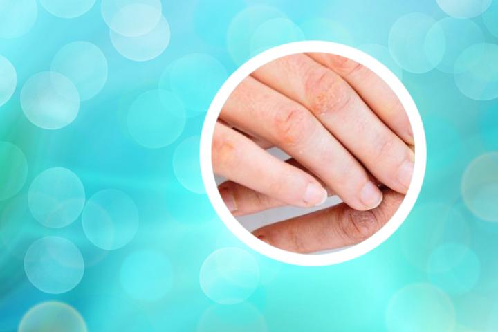银屑病发病机制研究
