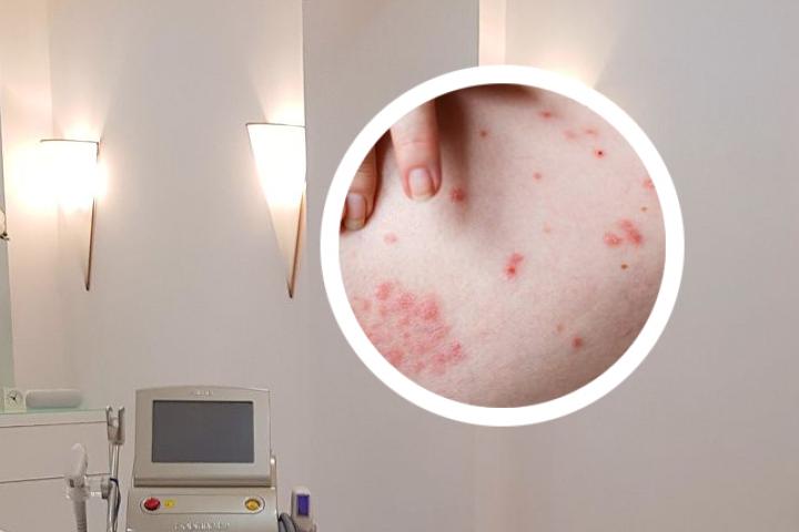生物制剂单抗银屑病