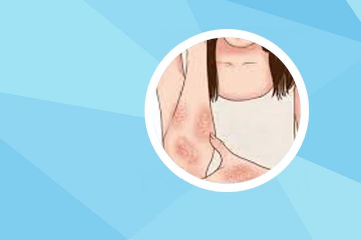 银屑病会传染么