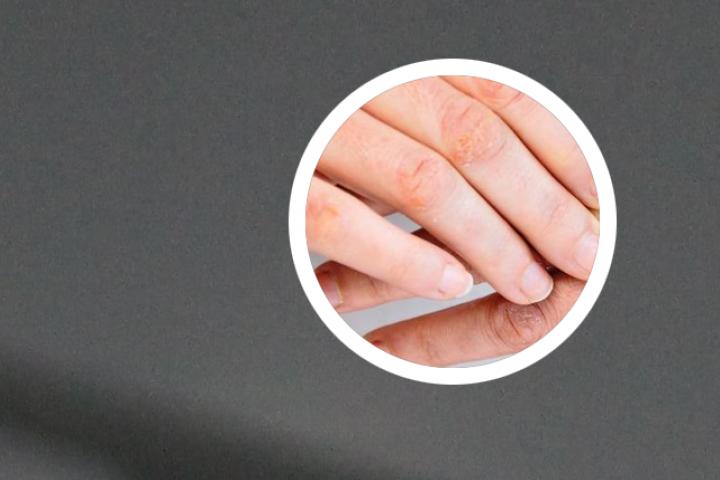 md多维银屑病治疗价格