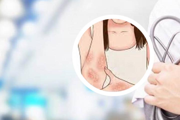 银屑病免疫系统疾病