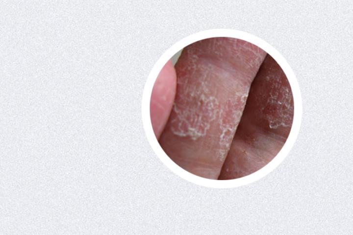 银屑病会越老越严重吗