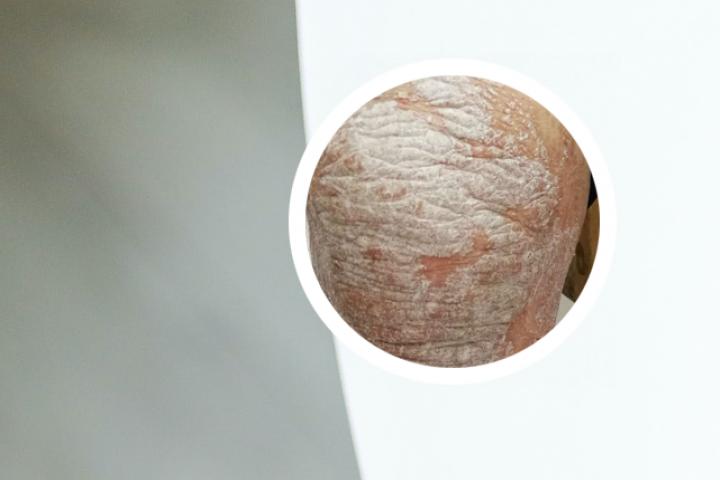 狼毒草可以治疗银屑病吗