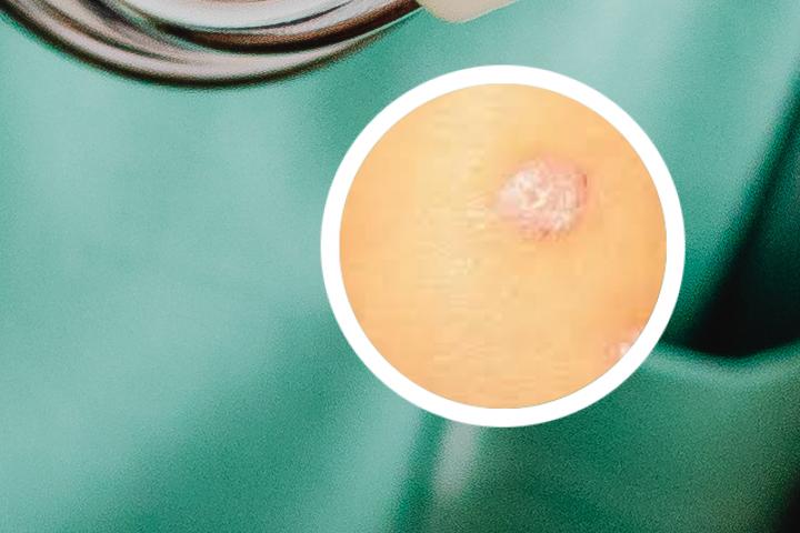 银屑病怎么治