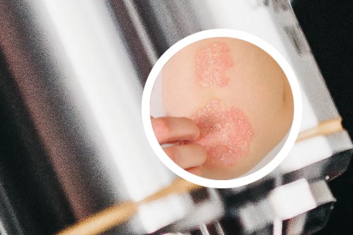 银屑病新针疗法