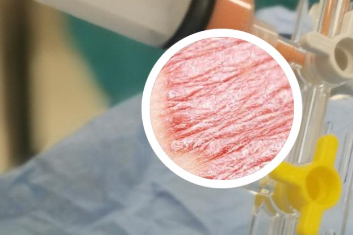 各种土方法防止牛皮癣