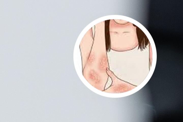 碘酒治愈牛皮癣