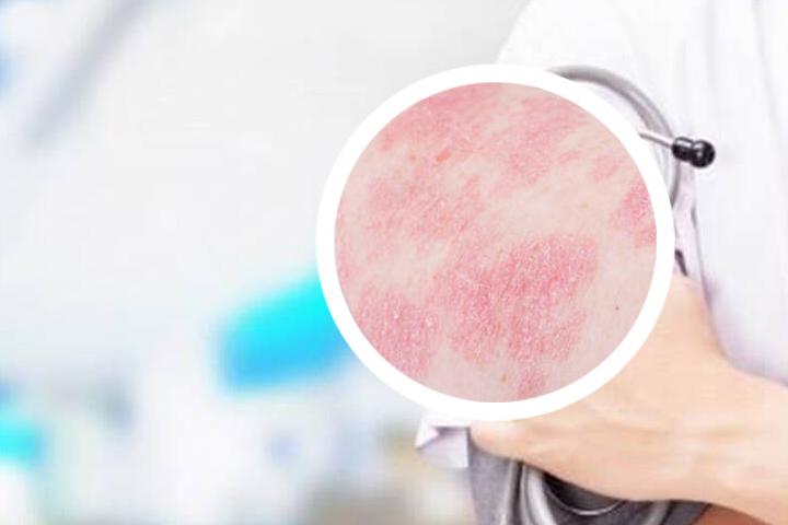 银屑病可以打宫颈癌疫苗吗