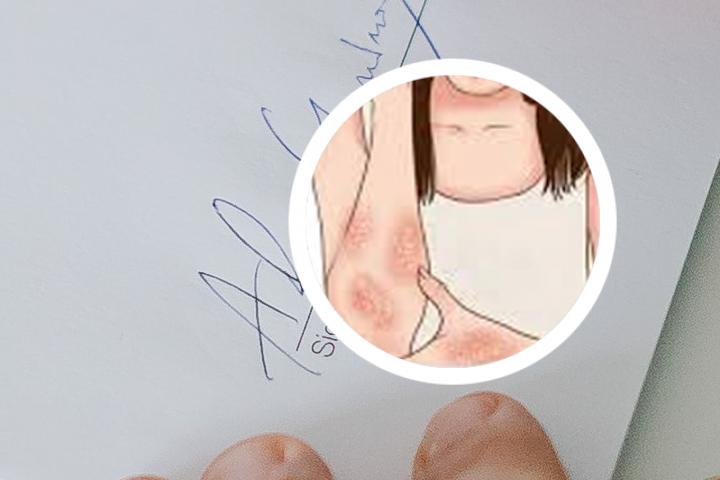 牛皮癣不能喝白酒