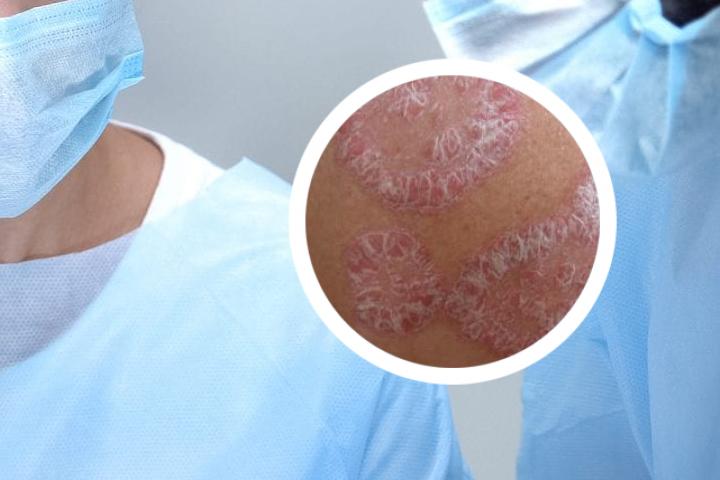 最著名老中医治疗银屑病